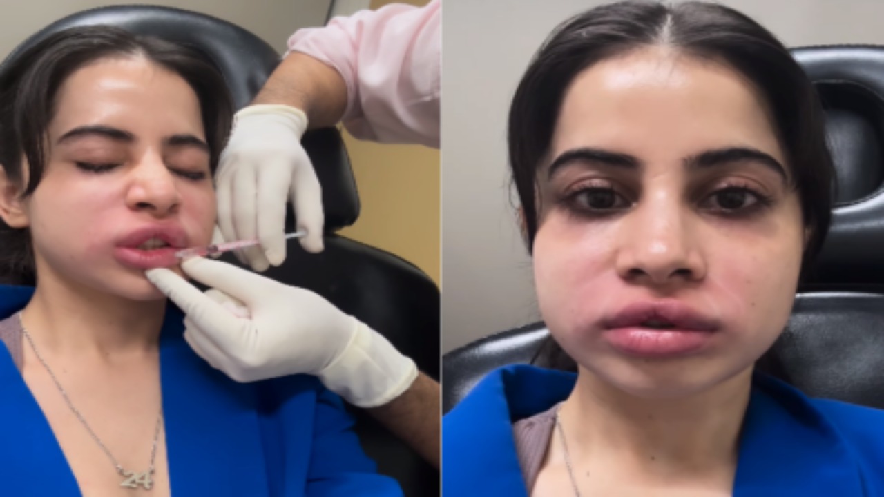 uorfi-javed-lip-filler-dissolution-natural-look