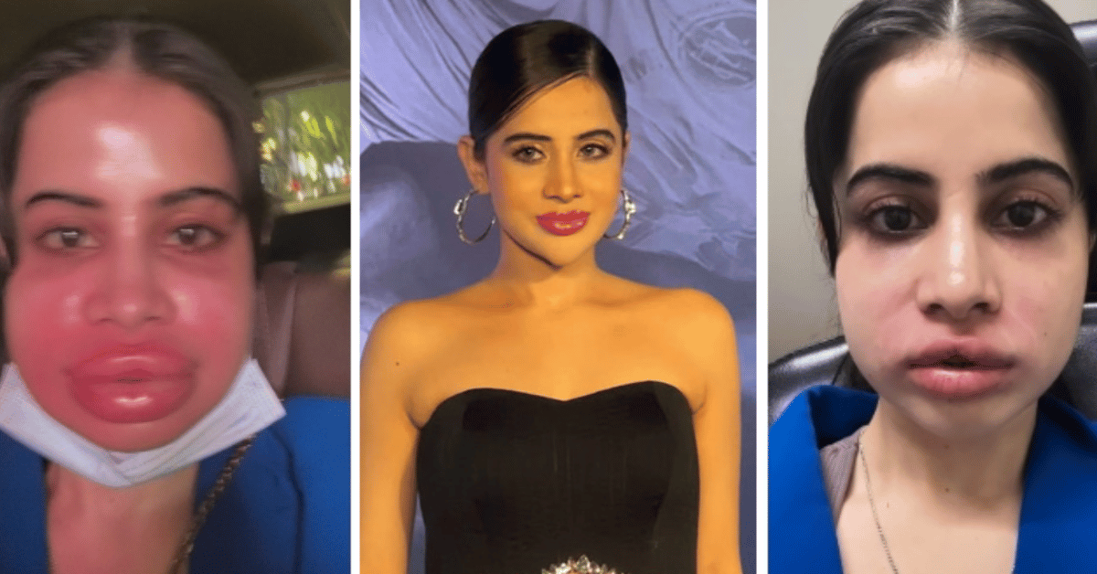 uorfi-javed-lip-filler-dissolution-natural-look